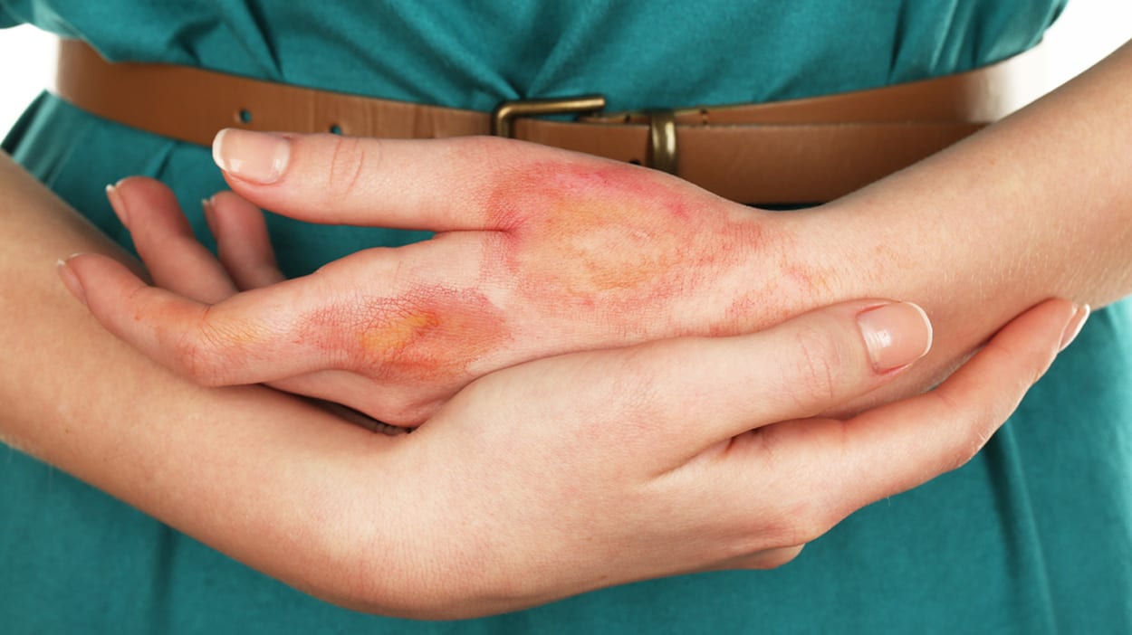 Preventing scars after a burn wound ALHYDRAN