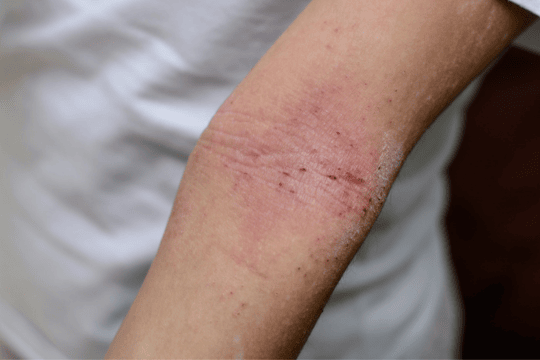 eczema arm